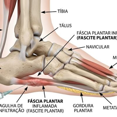 Fascite Plantar e Dor no Calcanhar
